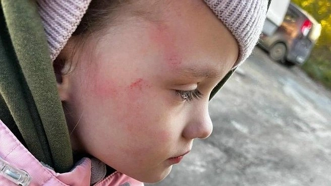 Мама из Асбеста обвинила воспитательницу в избиении пятилетней дочери в детском саду