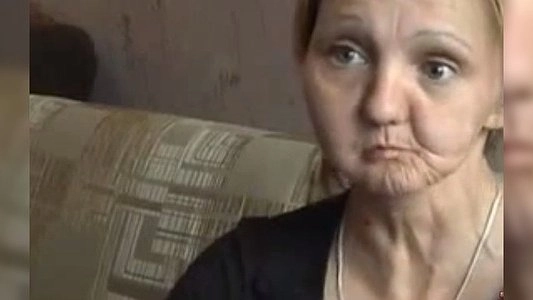 «Пусть говорят»: сохранить лицо - Анна Серпокрылова родилась с уродством - 22 июня 2015 года