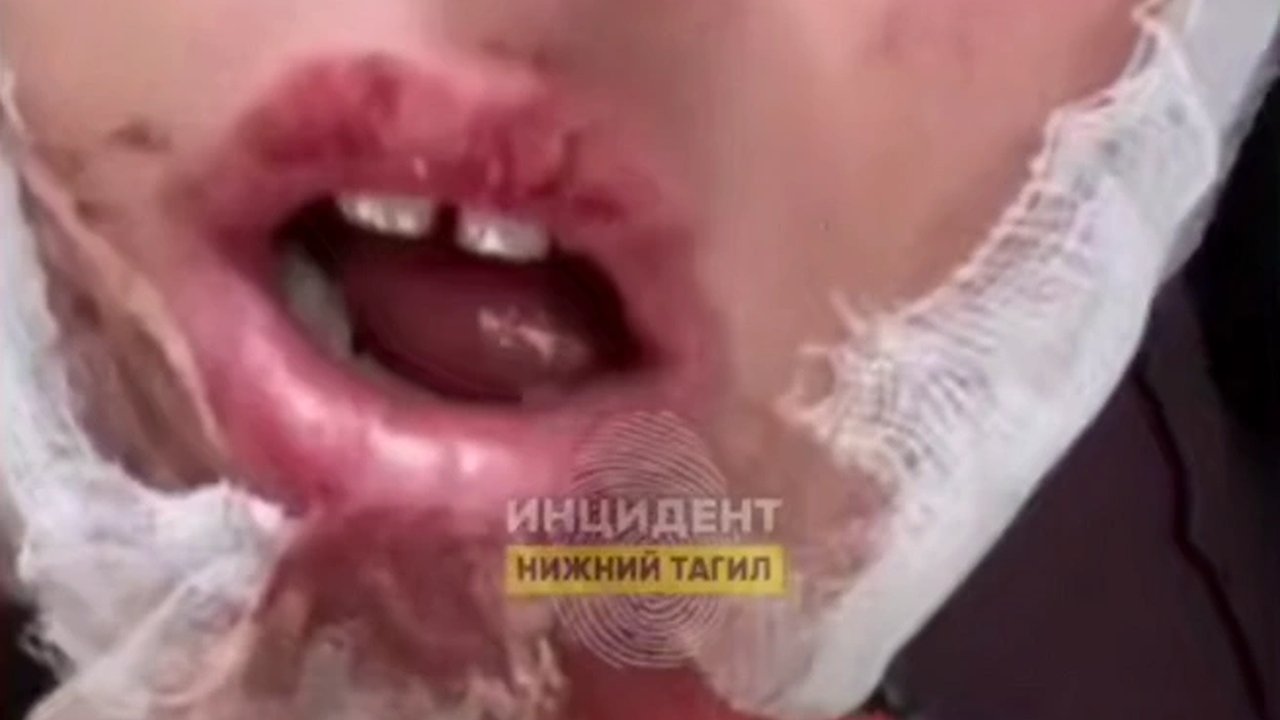 Главная картинка новости: Жестокое нападение на юного футболиста в Нижнем Тагиле: подростку сломали челюсть после матча