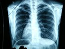 Врачи Свердловской области бьют тревогу: 85% случаев рака легких обнаруживают слишком поздно