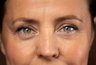Как убрать глубокую межбровную морщину в домашних условиях: причины и способы